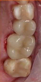 Composite-Fillings-After-Image