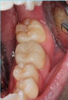 Cracked-Tooth-Repair-After-Image
