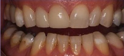 Crowns-Following-Root-Canals-After-Image