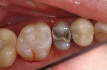 Partial-Coverage-Crown-After-Image