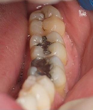 Composite-Fillings-Before-Image