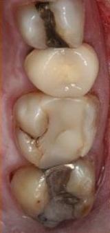 Composite-Fillings-Before-Image
