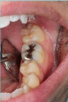 Cracked-Tooth-Repair-Before-Image