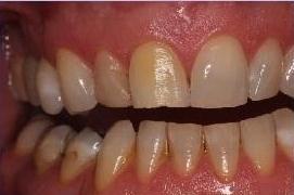 Crowns-Following-Root-Canals-Before-Image
