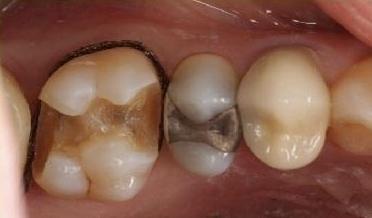 Partial-Coverage-Crown-Before-Image